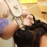 Medical Procedure for Alopecia Treatment