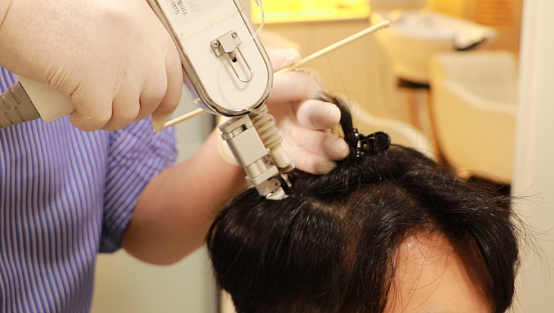 Medical Procedure for Alopecia Treatment