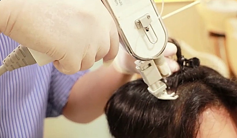 5 Mesotherapy for Alopecia