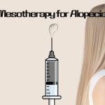 Mesotherapy for Alopecia