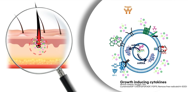 1Cytokines Mesotherapy for Alopecia 2