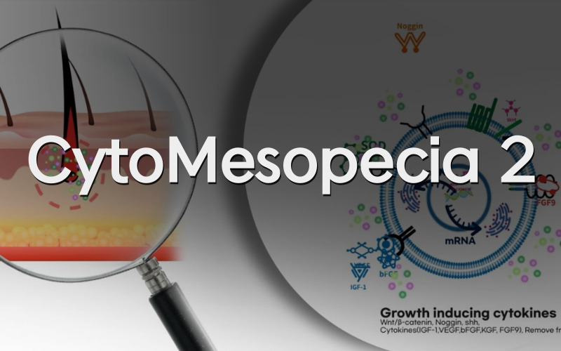 Cytokines Mesotherapy for Alopecia