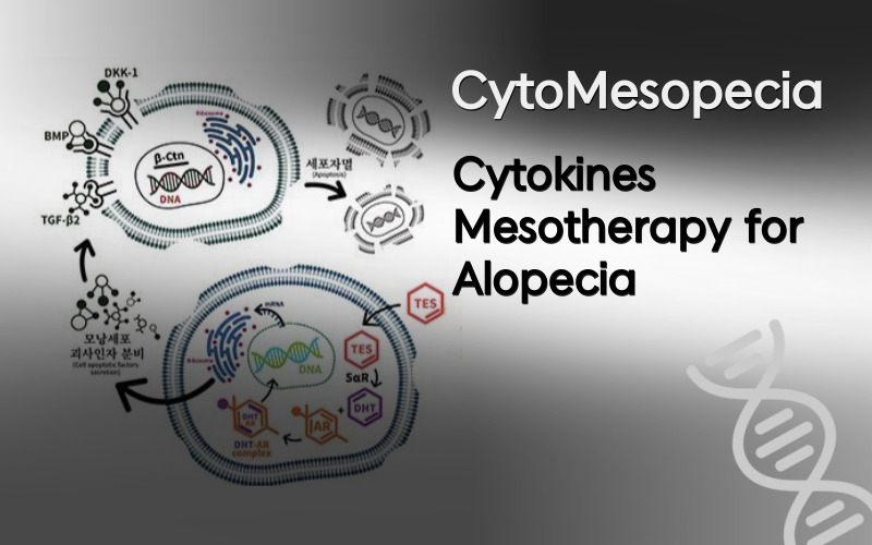 Cytokines Mesotherapy for Alopecia: